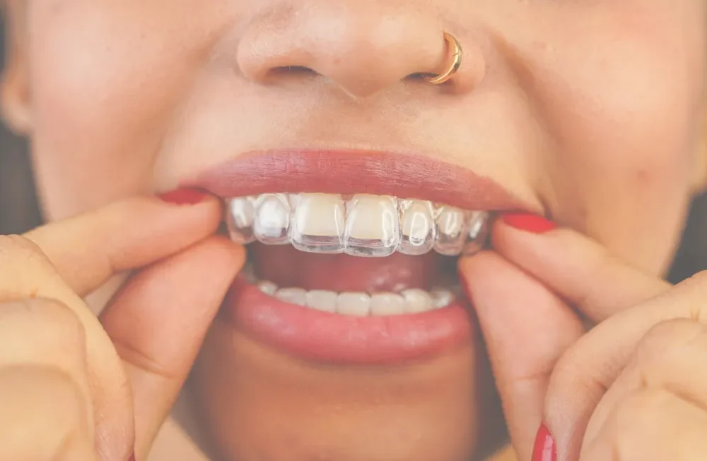 Aligner treatment can help patients explore a straighter smile with clear guidance before treatment begins. || Suitability depends on your teeth, bite and goals, so the team can explain what may be realistic before you decide.