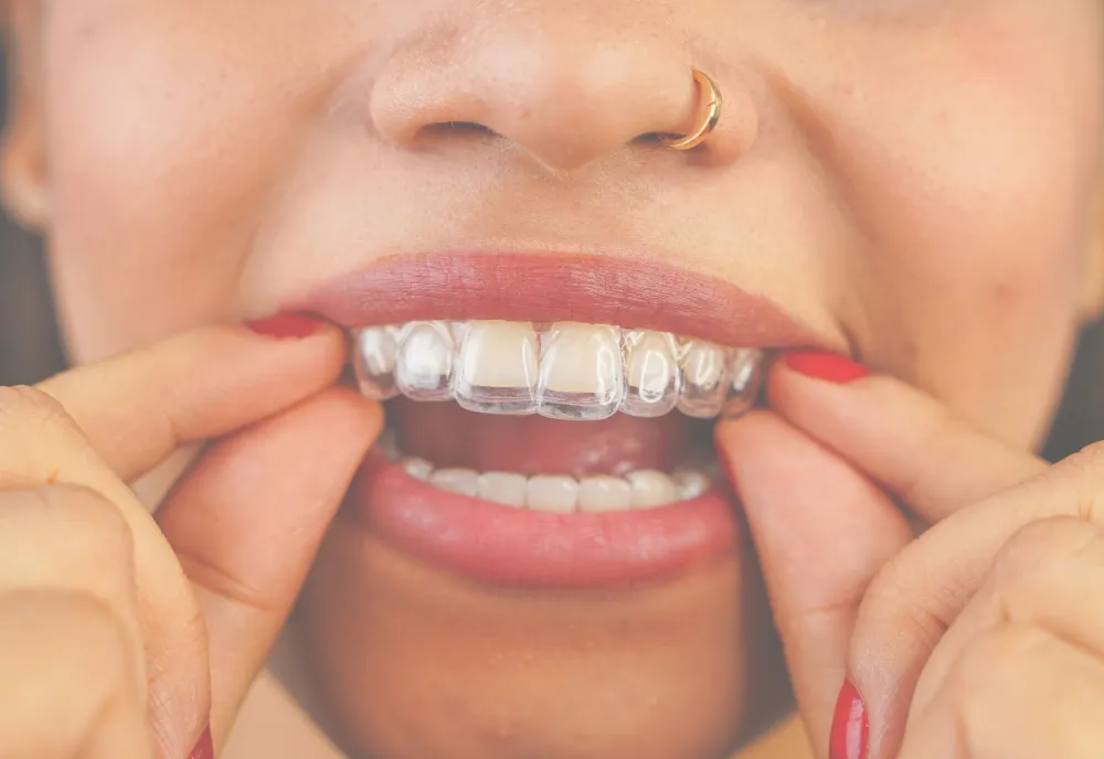 Aligner treatment can help patients explore a straighter smile with clear guidance before treatment begins. || Suitability depends on your teeth, bite and goals, so the team can explain what may be realistic before you decide.